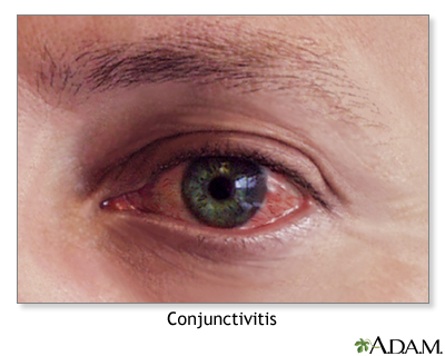 Conjunctivitis